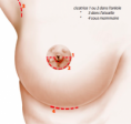 /album/galerie-photos/cicatrices-augmentation-mammaire1-png/